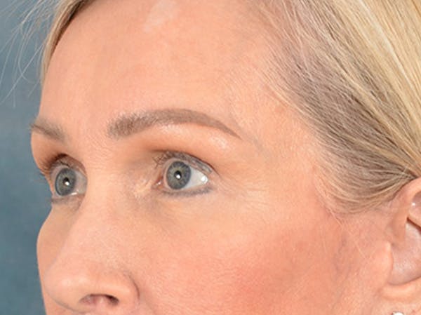 Eyelid Lift Before & After Gallery - Patient 400221 - Image 8