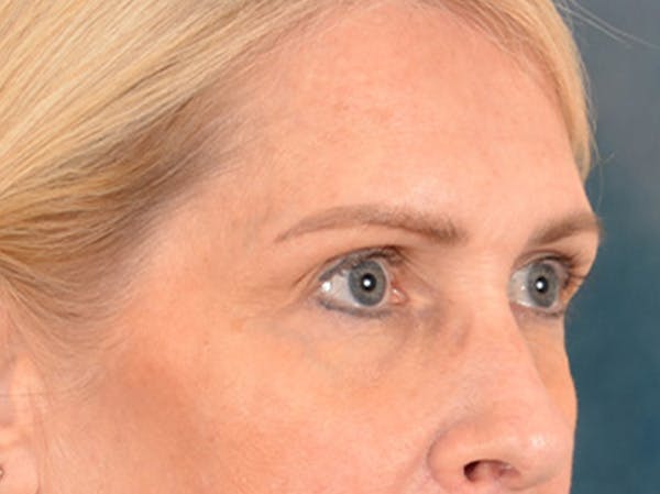Eyelid Lift Before & After Gallery - Patient 400221 - Image 3