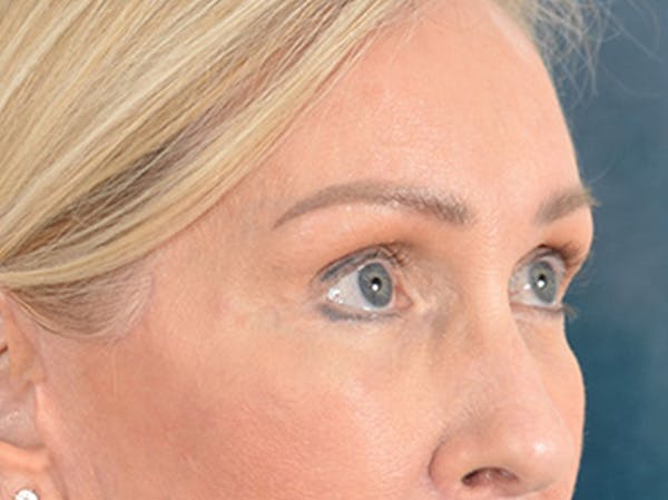 Eyelid Lift Before & After Gallery - Patient 400221 - Image 4