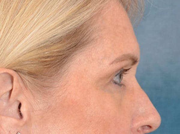 Eyelid Lift Before & After Gallery - Patient 400221 - Image 5