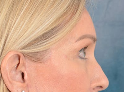 Eyelid Lift Before & After Gallery - Patient 400221 - Image 6