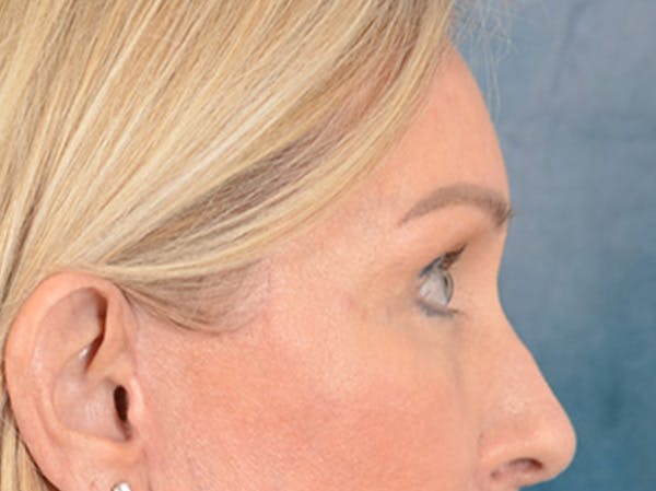 Eyelid Lift Before & After Gallery - Patient 400221 - Image 6