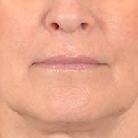 Lip Lift Before & After Gallery - Patient 337797 - Image 1