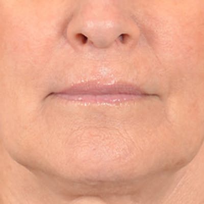 Lip Lift Before & After Gallery - Patient 337797 - Image 1