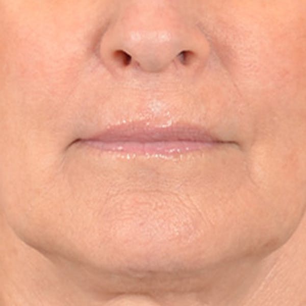Lip Lift Before & After Gallery - Patient 337797 - Image 1
