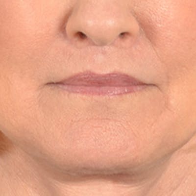 Lip Lift Before & After Gallery - Patient 337797 - Image 2