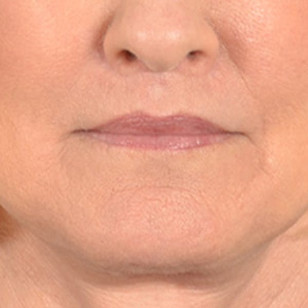 Lip Lift Before & After Gallery - Patient 337797 - Image 2