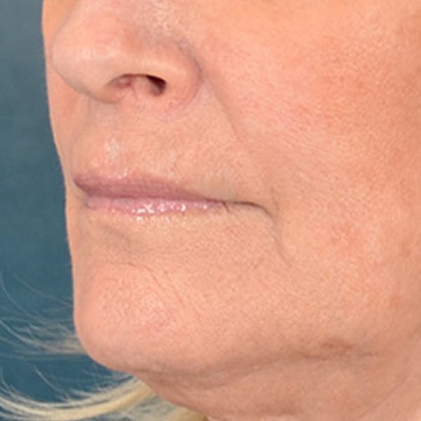 Lip Lift Before & After Gallery - Patient 337797 - Image 7