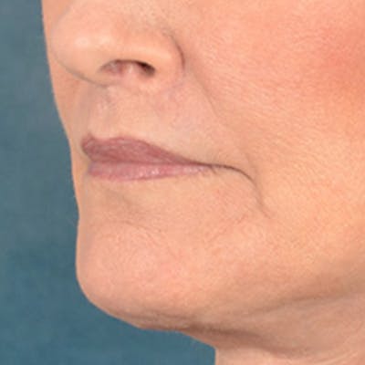 Lip Lift Before & After Gallery - Patient 337797 - Image 8