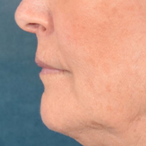 Lip Lift Before & After Gallery - Patient 337797 - Image 9