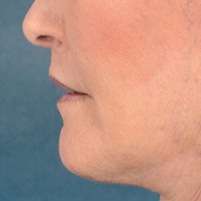 Lip Lift Before & After Gallery - Patient 337797 - Image 10