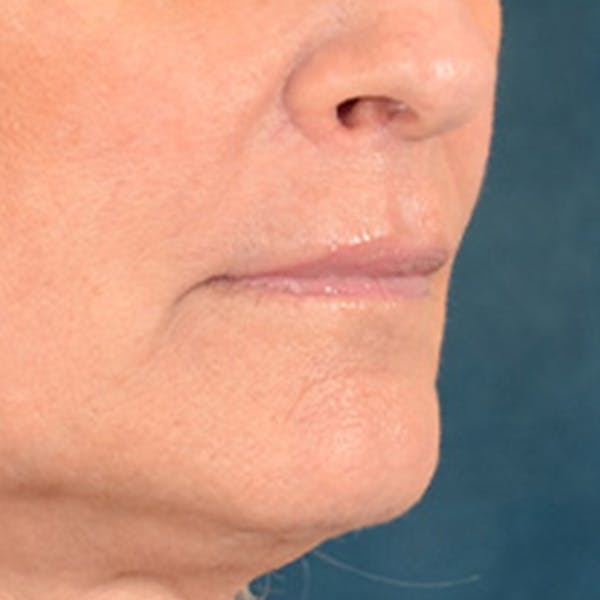 Lip Lift Before & After Gallery - Patient 337797 - Image 3