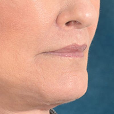 Lip Lift Before & After Gallery - Patient 337797 - Image 4