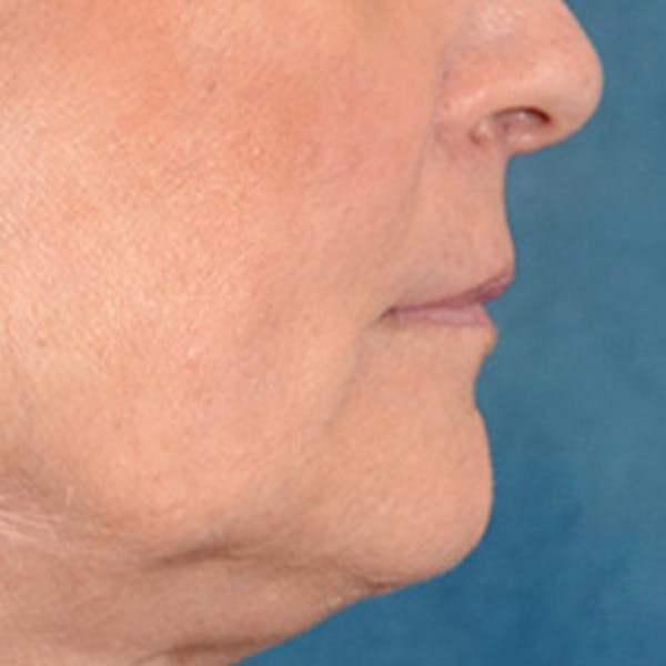 Lip Lift Before & After Gallery - Patient 337797 - Image 5