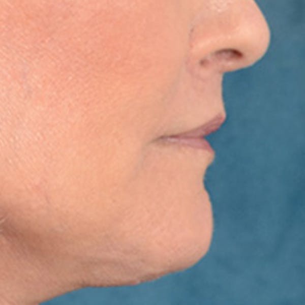 Lip Lift Before & After Gallery - Patient 337797 - Image 6