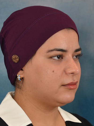 Rhinoplasty Before & After Gallery - Patient 225741 - Image 8