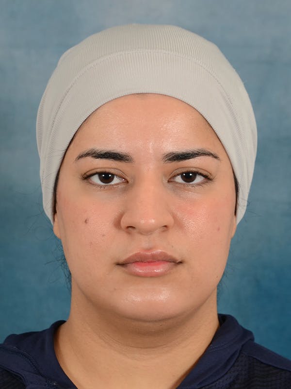 Rhinoplasty Before & After Gallery - Patient 225741 - Image 5