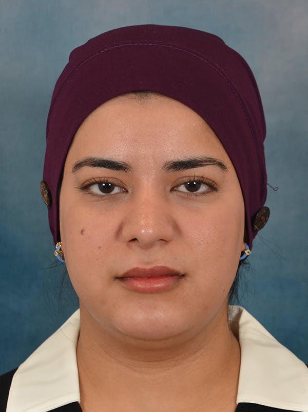 Rhinoplasty Before & After Gallery - Patient 225741 - Image 6