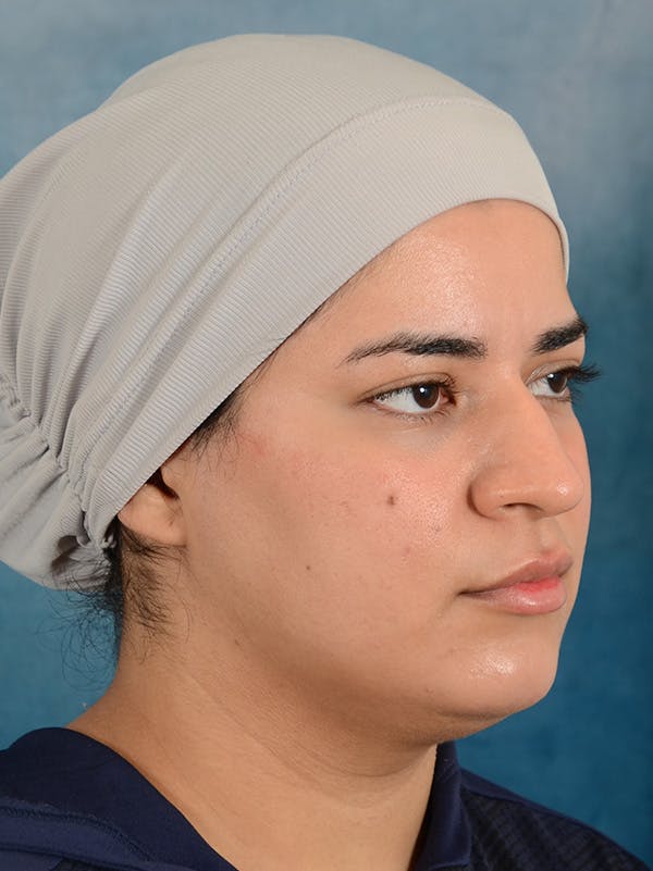 Rhinoplasty Before & After Gallery - Patient 225741 - Image 7