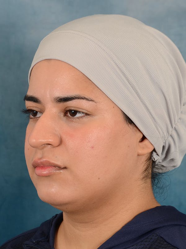 Rhinoplasty Before & After Gallery - Patient 225741 - Image 3