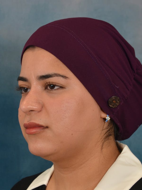 Rhinoplasty Before & After Gallery - Patient 225741 - Image 4