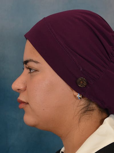 Rhinoplasty Before & After Gallery - Patient 225741 - Image 2