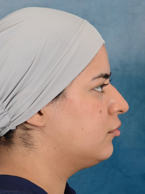 Rhinoplasty Before & After Gallery - Patient 225741 - Image 9