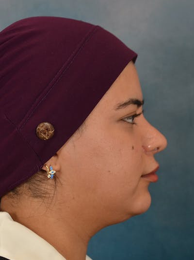 Rhinoplasty Before & After Gallery - Patient 225741 - Image 10