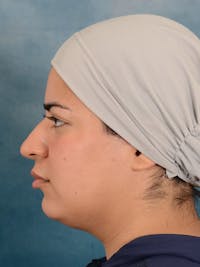 Rhinoplasty Before & After Gallery - Patient 225741 - Image 1