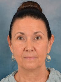 Brow Lift Before & After Gallery - Patient 359475 - Image 1
