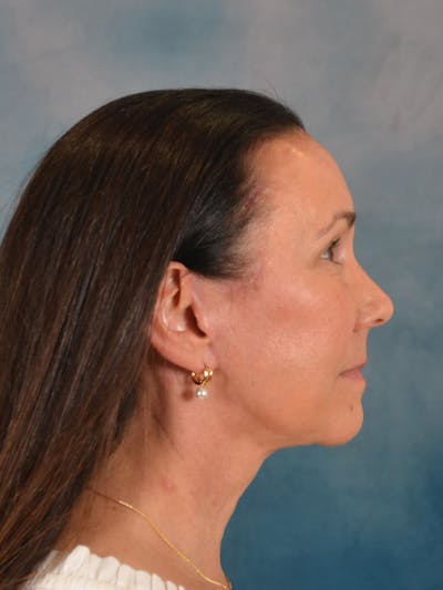 Brow Lift Before & After Gallery - Patient 359475 - Image 8