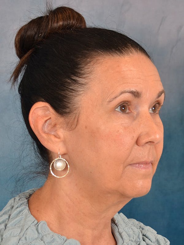 Brow Lift Before & After Gallery - Patient 359475 - Image 5