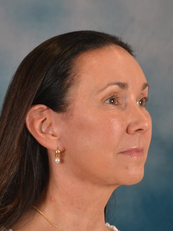 Brow Lift Before & After Gallery - Patient 359475 - Image 6