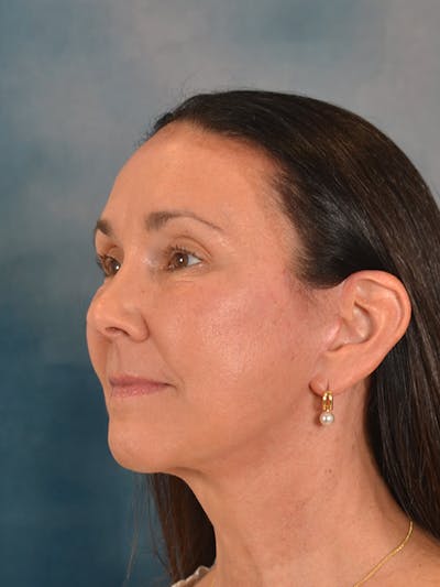 Brow Lift Before & After Gallery - Patient 359475 - Image 4