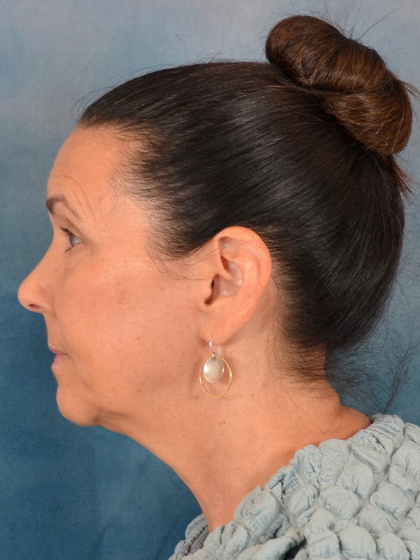 Brow Lift Before & After Gallery - Patient 359475 - Image 9