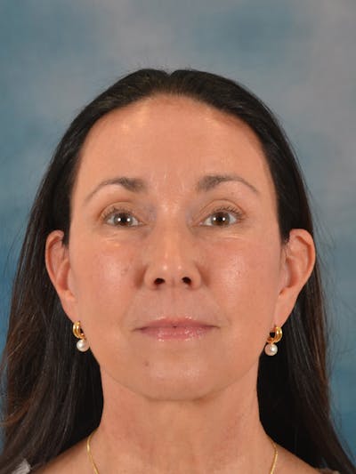 Deep Neck Lift Before & After Gallery - Patient 244728 - Image 2