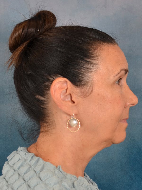 Brow Lift Before & After Gallery - Patient 359475 - Image 7