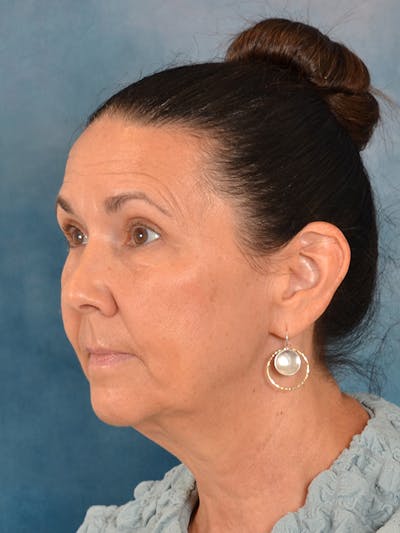 Deep Plane Facelift Before & After Gallery - Patient 256022 - Image 1