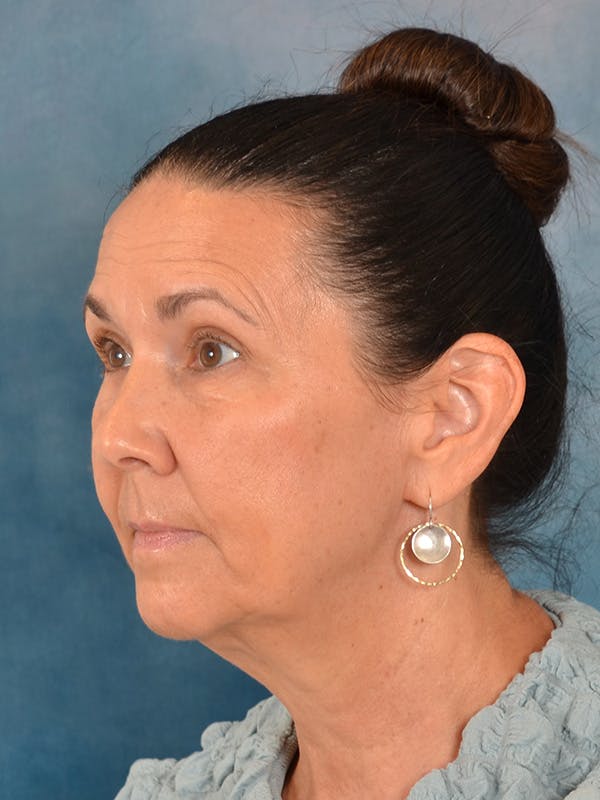 Brow Lift Before & After Gallery - Patient 359475 - Image 3