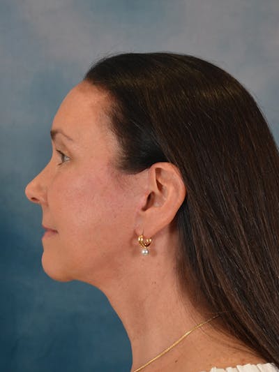 Brow Lift Before & After Gallery - Patient 359475 - Image 10