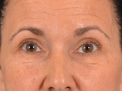 Eyelid Lift Before & After Gallery - Patient 113846 - Image 1