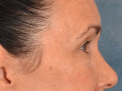 Eyelid Lift Before & After Gallery - Patient 113846 - Image 6