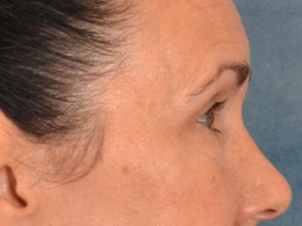Eyelid Lift Before & After Gallery - Patient 113846 - Image 6