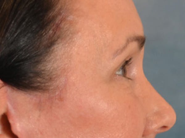 Eyelid Lift Before & After Gallery - Patient 113846 - Image 5