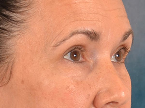 Eyelid Lift Before & After Gallery - Patient 113846 - Image 3