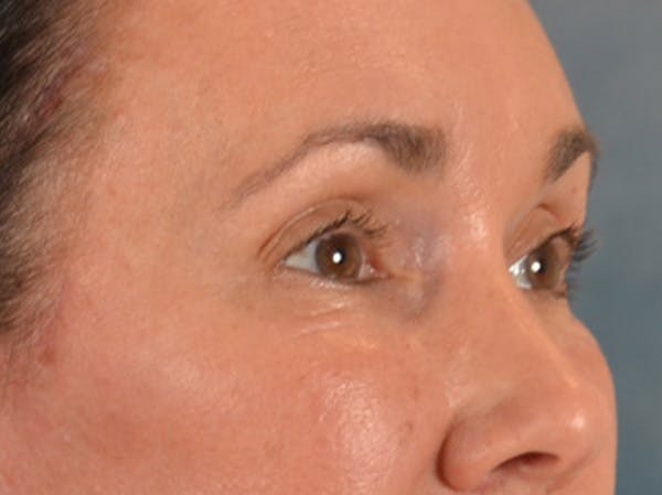Eyelid Lift Before & After Gallery - Patient 113846 - Image 4