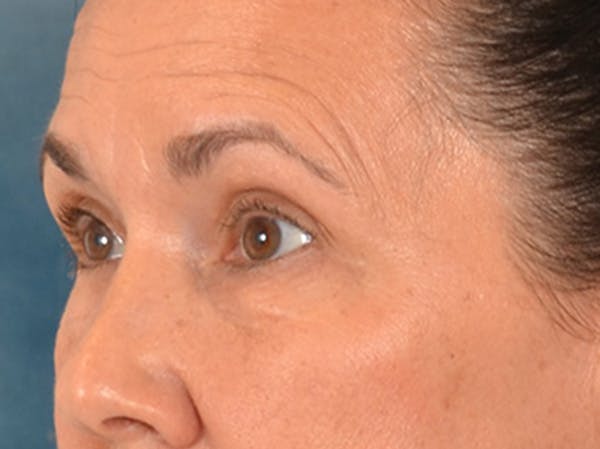 Eyelid Lift Before & After Gallery - Patient 113846 - Image 7