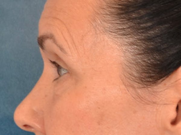 Eyelid Lift Before & After Gallery - Patient 113846 - Image 9