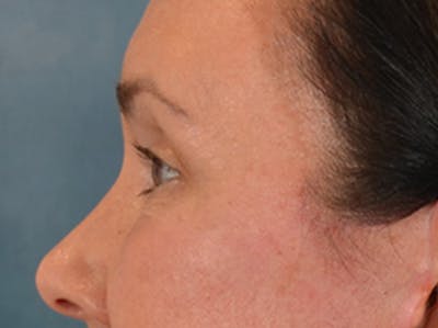 Eyelid Lift Before & After Gallery - Patient 113846 - Image 10