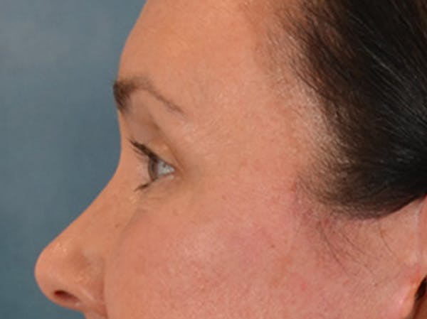 Eyelid Lift Before & After Gallery - Patient 113846 - Image 10